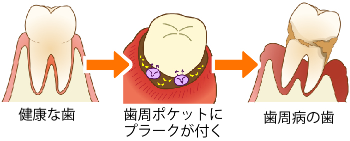 歯周病の進行イメージイラスト