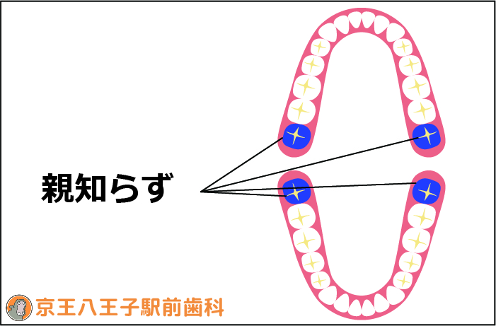 親知らずの図