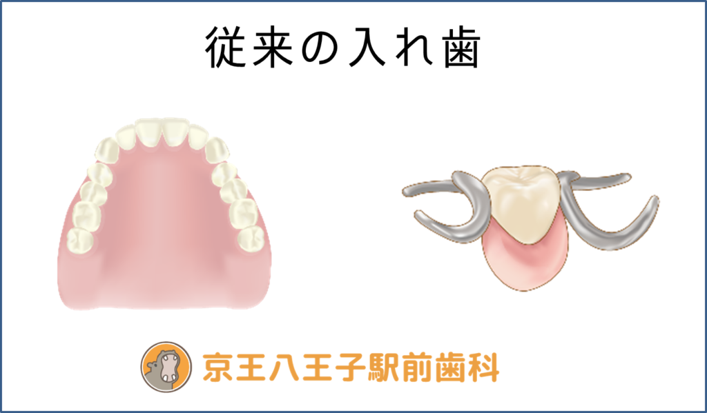従来の入れ歯