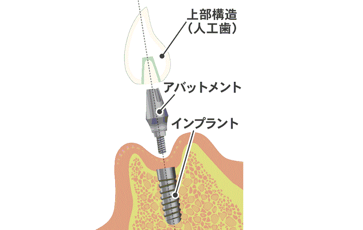 インプラント構造